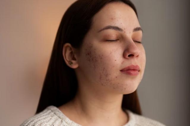 How does Mccosmetics Melanopeel Cream 30ml Reduce Dark Spots Effectively?